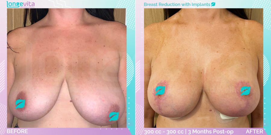 Breast Implant and Breast Reduction before and after, Breast, 20s female patient