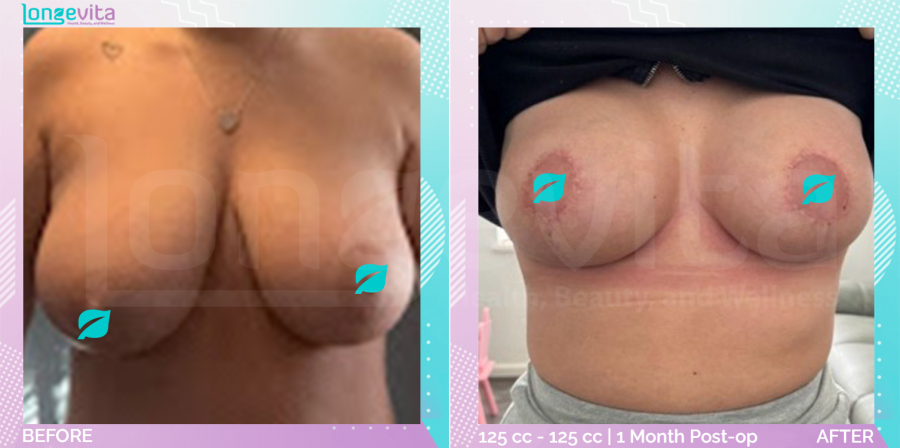 Breast Implant and Breast Reduction before and after, Breast, 20s female patient