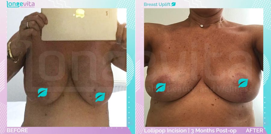 Breast Lift before and after, Breast