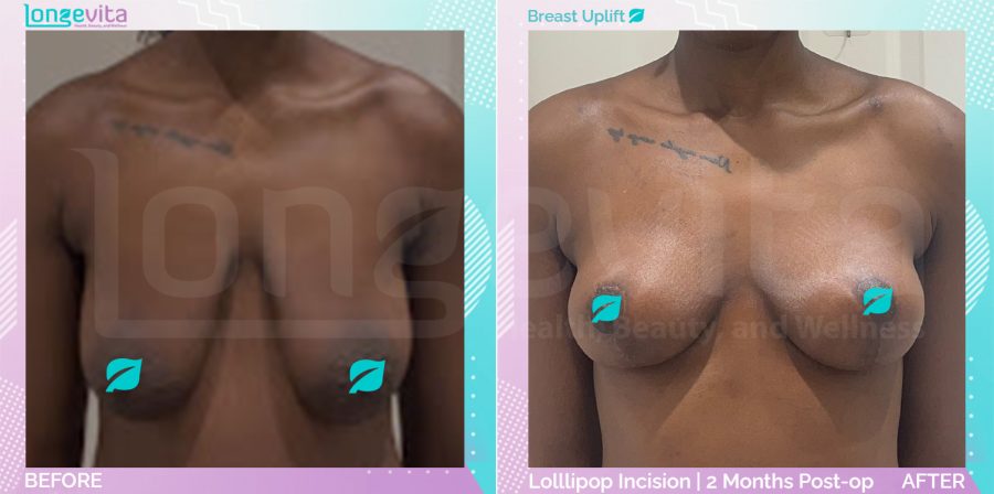 Breast Lift before and after, Breast, 20s female patient
