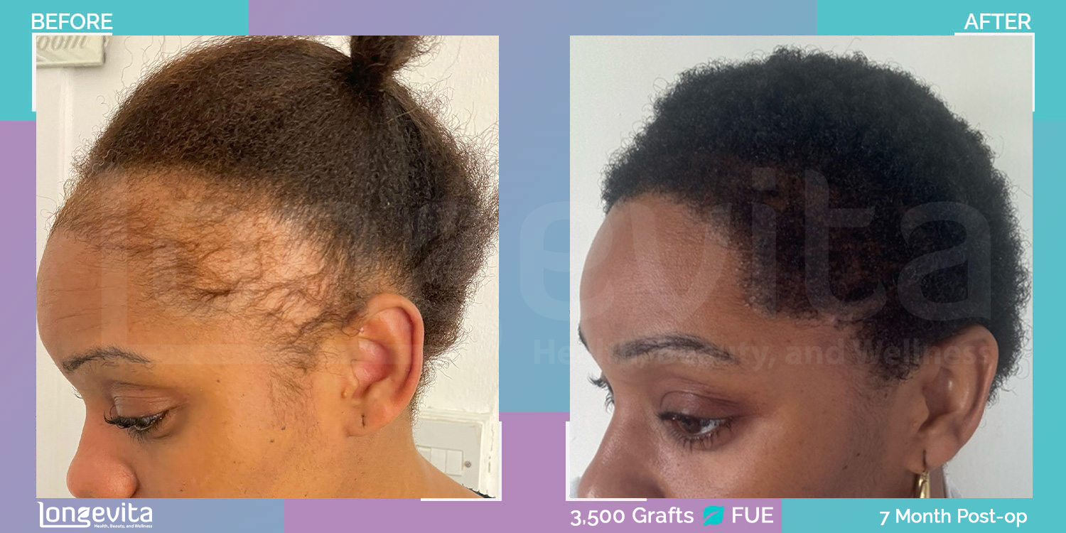 FUE hair transplant before and after, 3500 grafts, 3 zones covered, 30s female patient