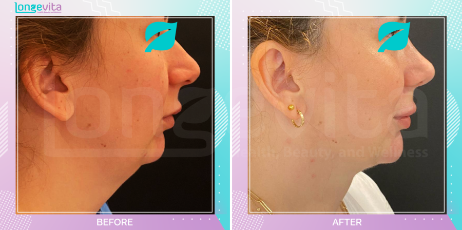 Liposuction before and after, Face