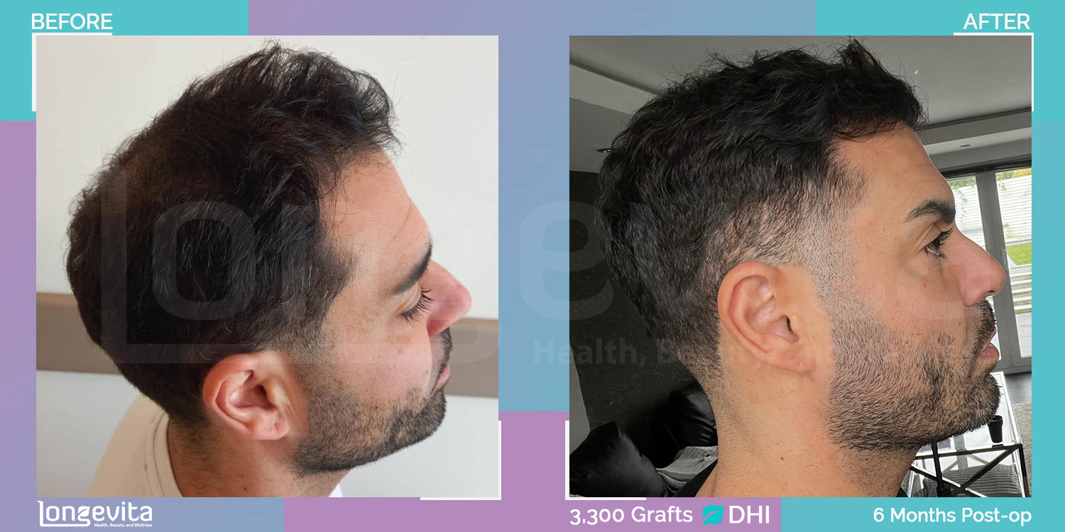 DHI hair transplant before and after, 3300 grafts, 2 zones covered, 30s male patient