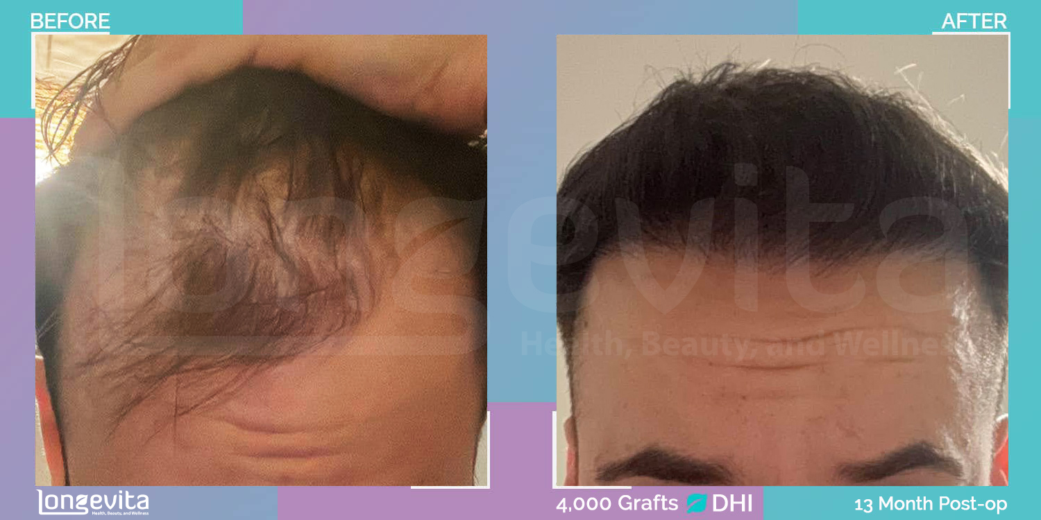 DHI hair transplant before and after, 4000 grafts, 3 zones covered, 20s male patient