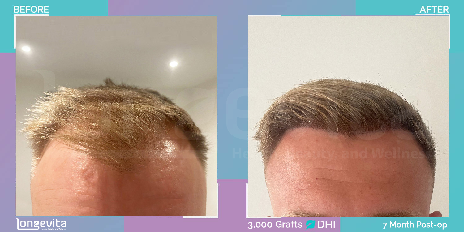 DHI hair transplant before and after, 3000 grafts, 2 zones covered, 20s male patient