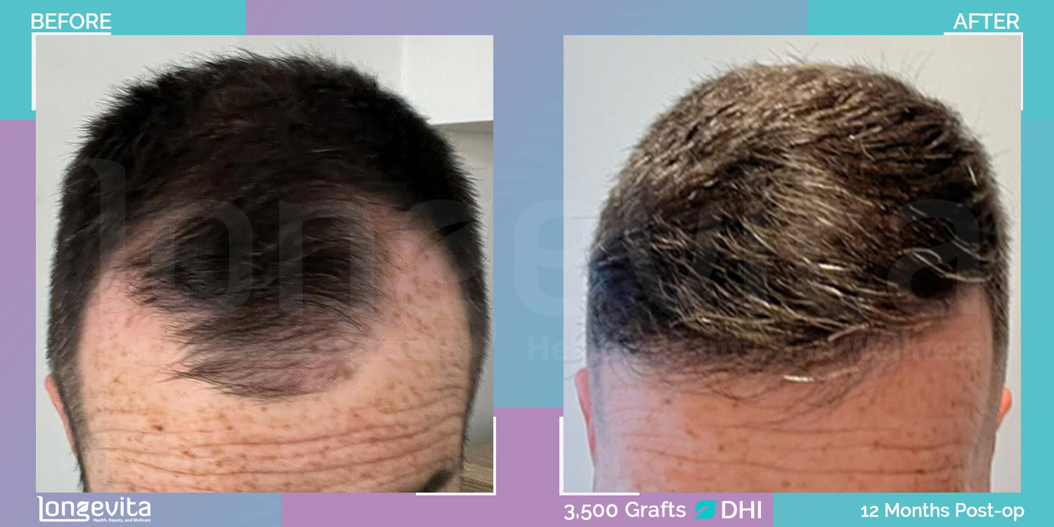 DHI hair transplant before and after, 3500 grafts, 4 zones covered, 30s male patient