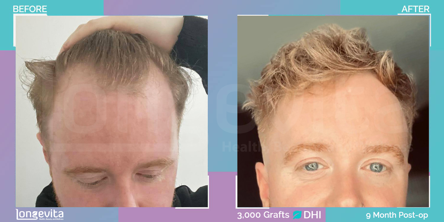 DHI hair transplant before and after, 3000 grafts, 3 zones covered, 30s male patient