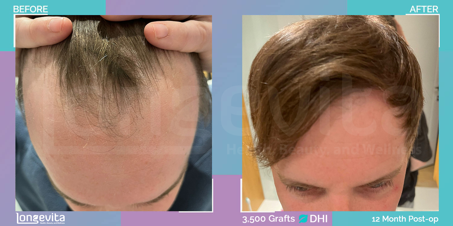 DHI hair transplant before and after, 3500 grafts, 5 zones covered, 30s male patient