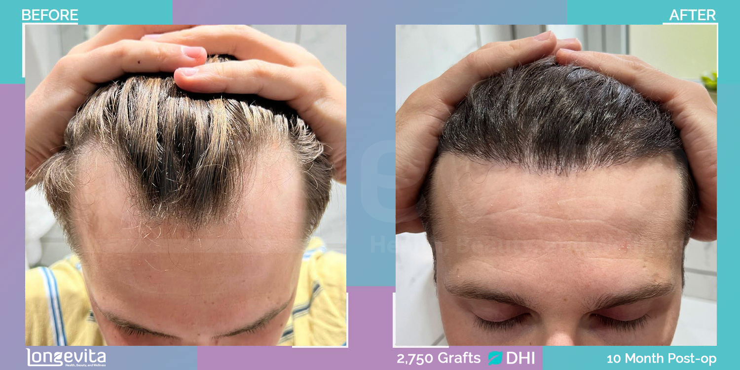 DHI hair transplant before and after, 2750 grafts, 1 zone covered, 20s male patient