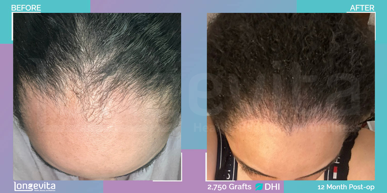 DHI hair transplant before and after, 2750 grafts, 2 zones covered, 30s female patient