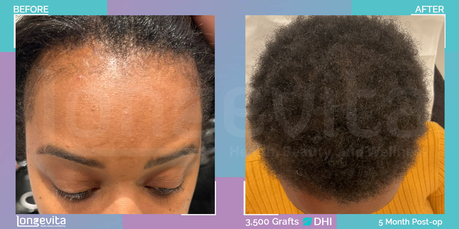 DHI hair transplant before and after, 3500 grafts, 2 zones covered, 30s female patient