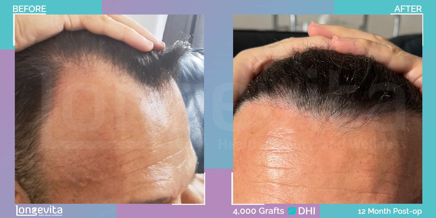 DHI hair transplant before and after, 4000 grafts, 5 zones covered, 40s male patient