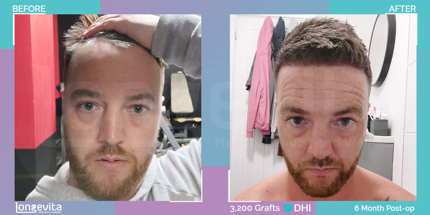 DHI hair transplant before and after, 3200 grafts, 2 zones covered, 30s male patient