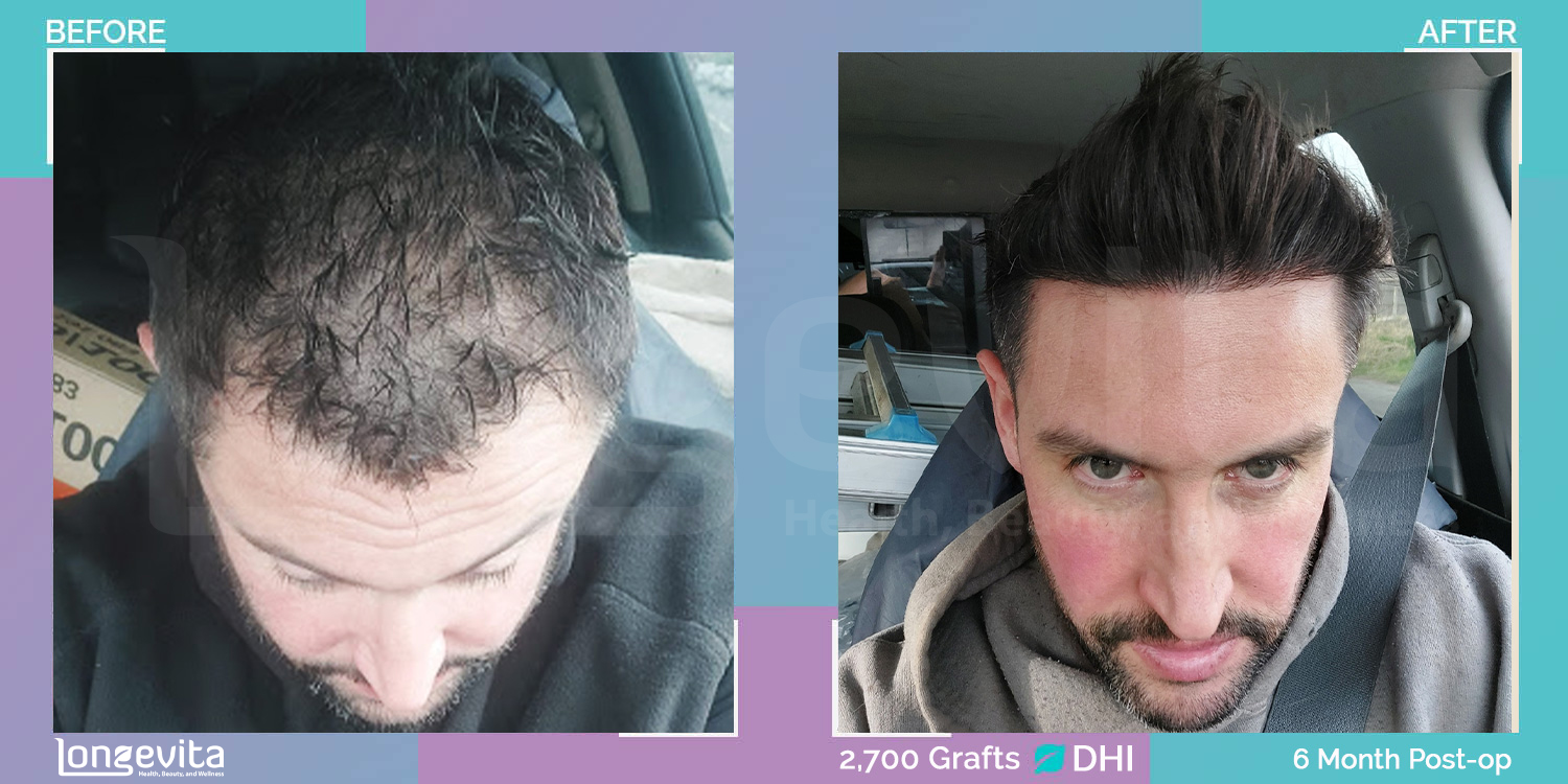 DHI hair transplant before and after, 2700 grafts, 5 zones covered, 40s male patient