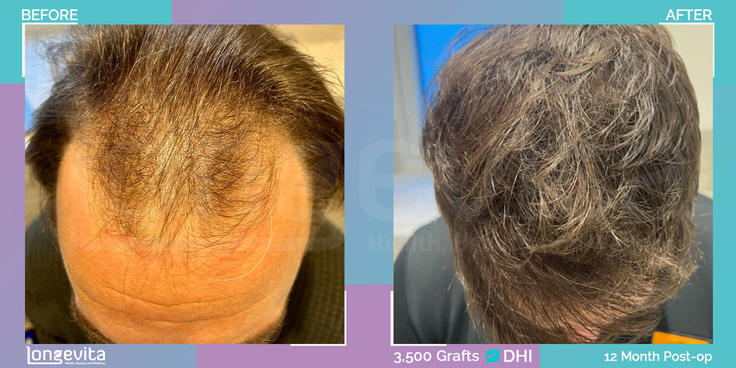 DHI hair transplant before and after, 3500 grafts, 3 zones covered, 30s male patient