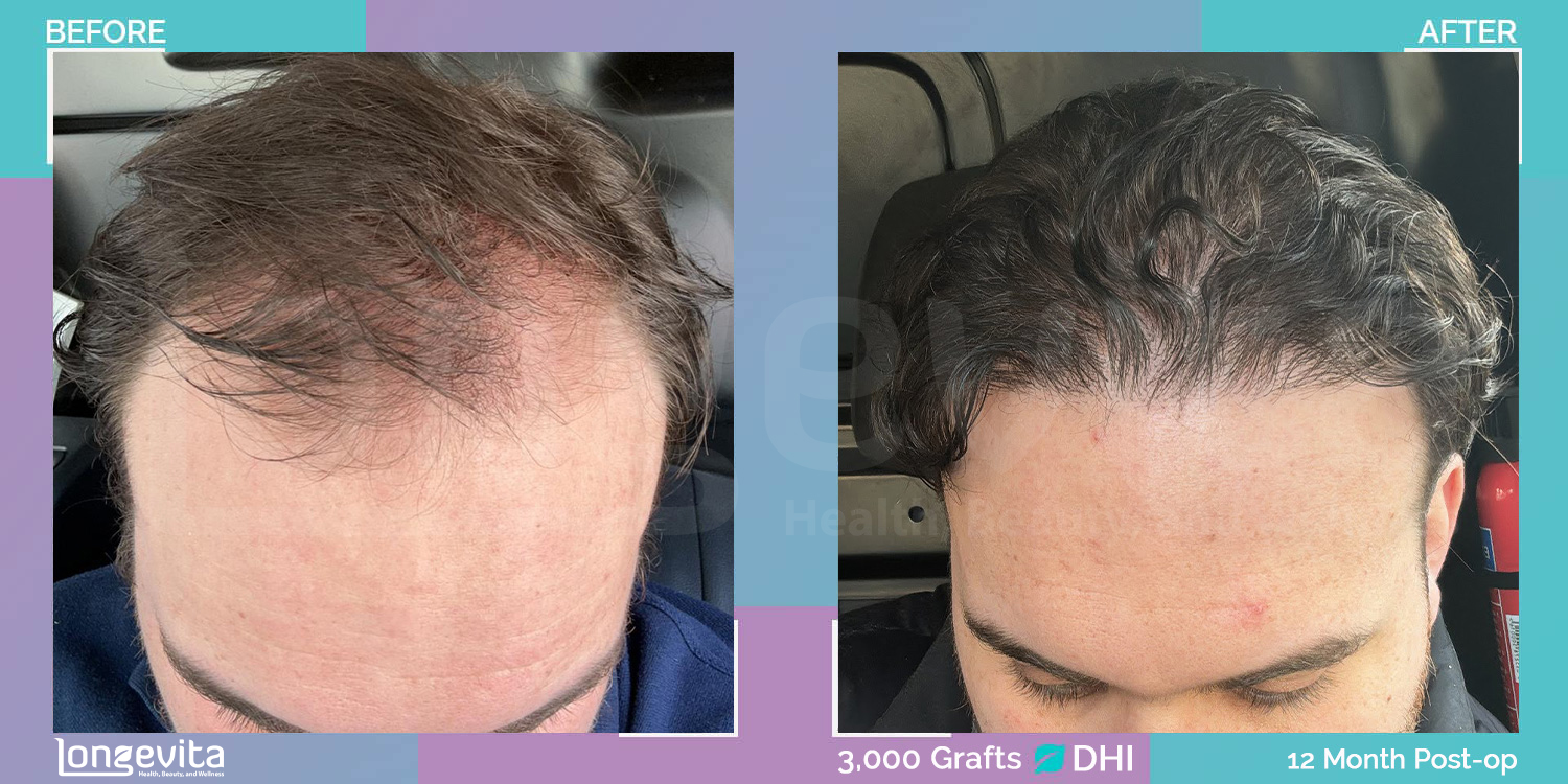DHI hair transplant before and after, 3000 grafts, 3 zones covered, 20s male patient