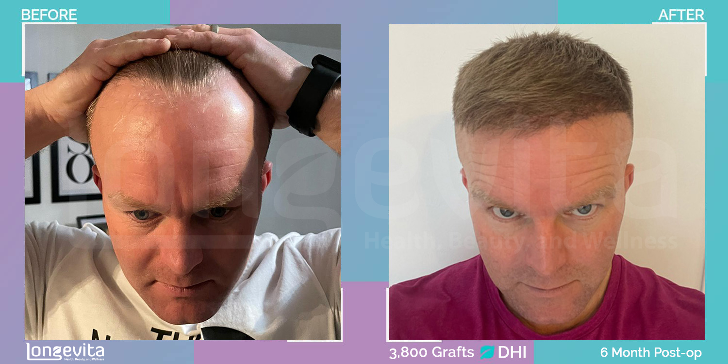 DHI hair transplant before and after, 3800 grafts, 2 zones covered, 30s male patient