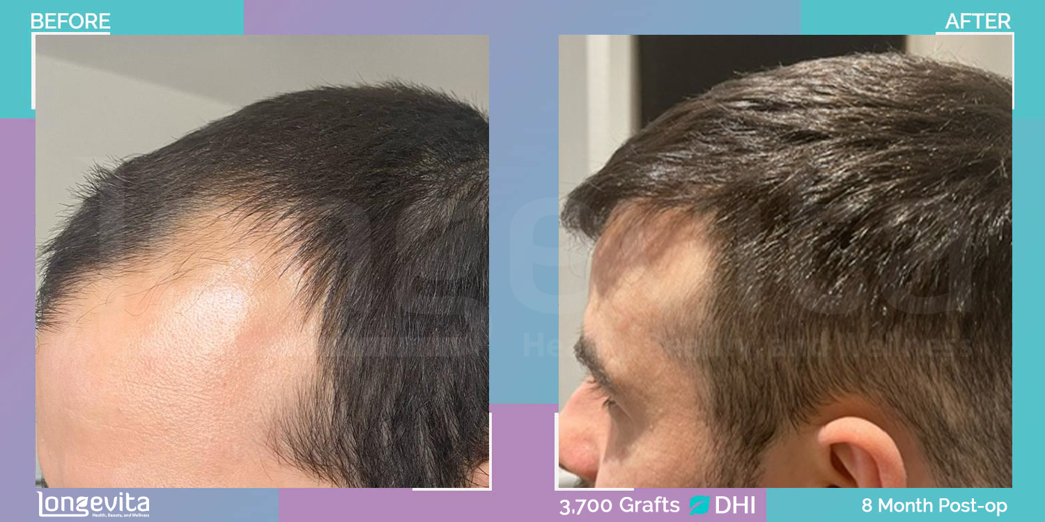 DHI hair transplant before and after, 3700 grafts, 3 zones covered, 30s male patient