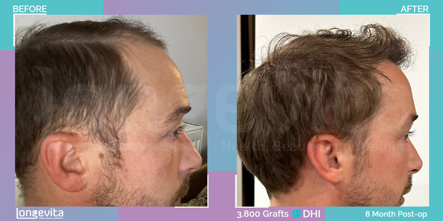 DHI hair transplant before and after, 3500 grafts, 3 zones covered, 30s male patient