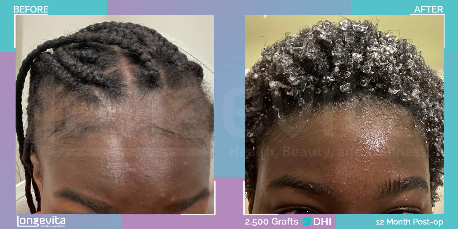 DHI hair transplant before and after, 2500 grafts, 2 zones covered, 20s female patient