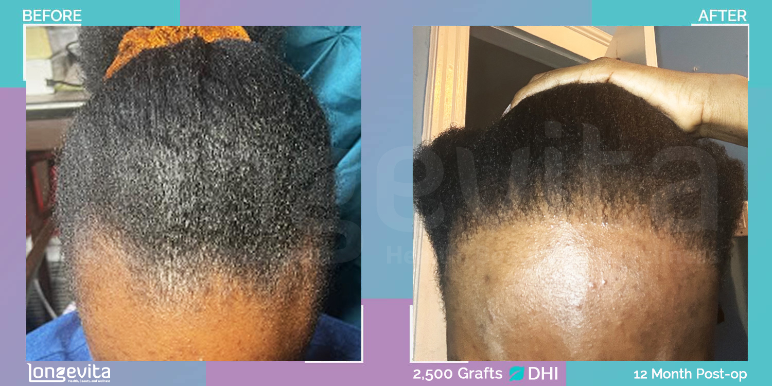 DHI hair transplant before and after, 2500 grafts, 2 zones covered, 20s female patient