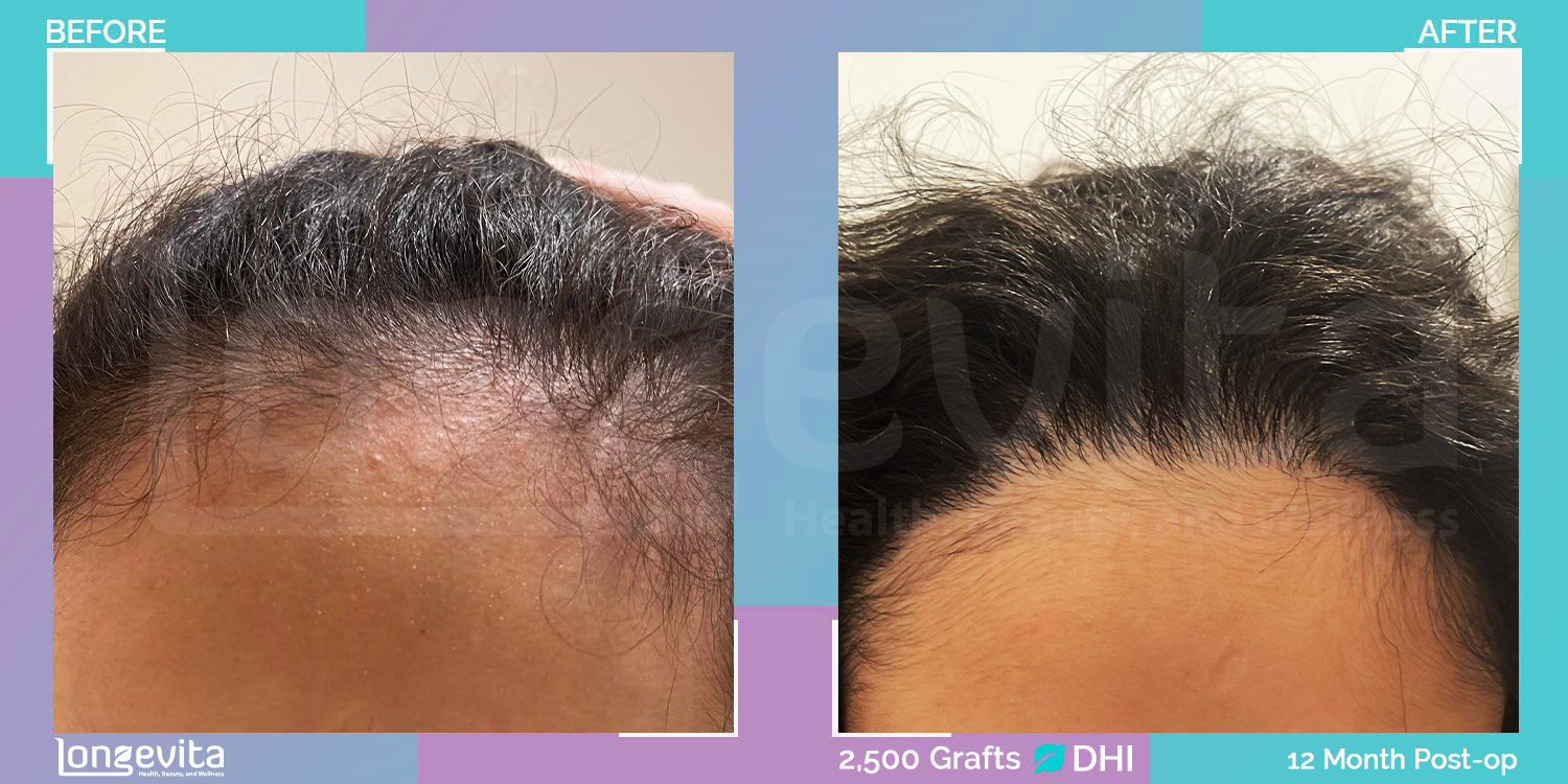 DHI hair transplant before and after, 2500 grafts, 1 zone covered, 20s female patient