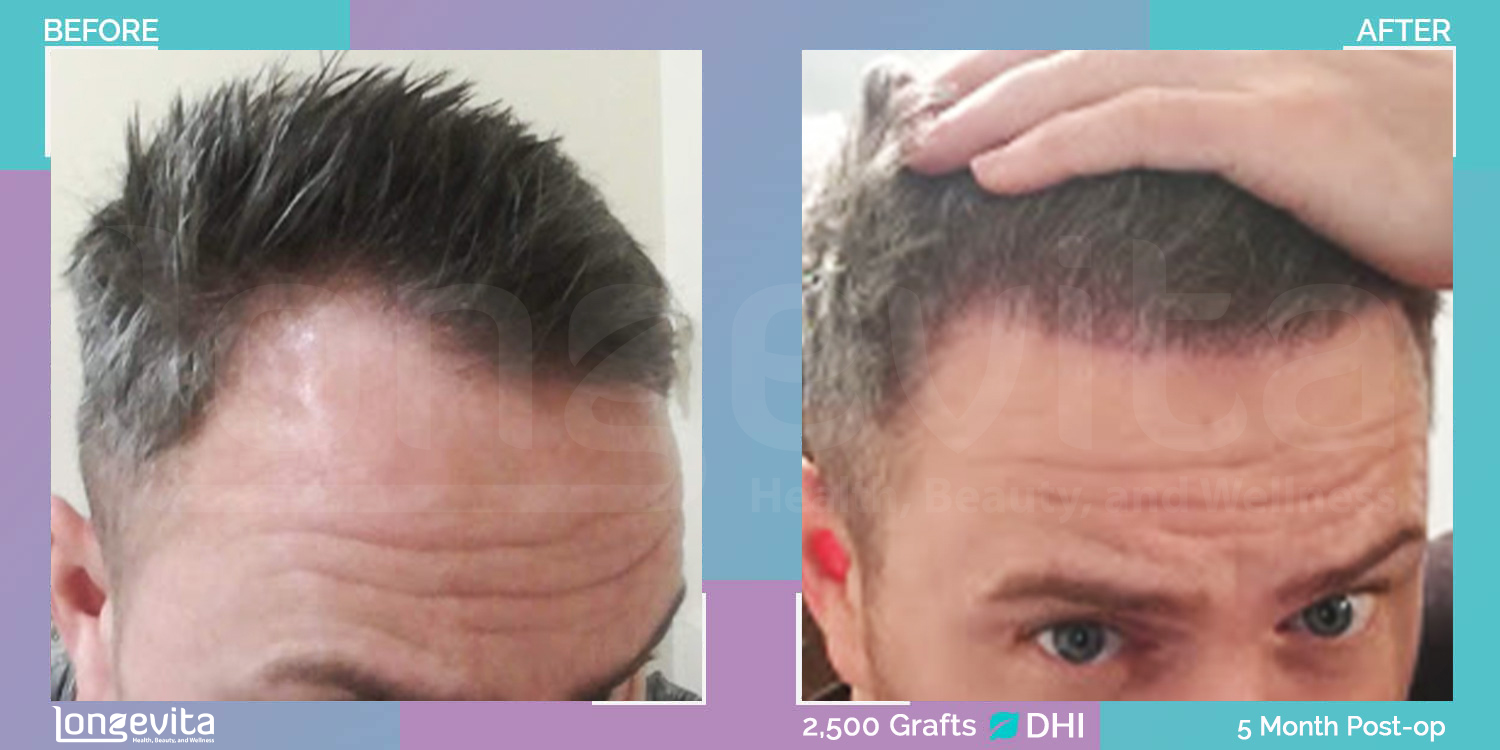 DHI hair transplant before and after, 3000 grafts, 4 zones covered, 30s male patient