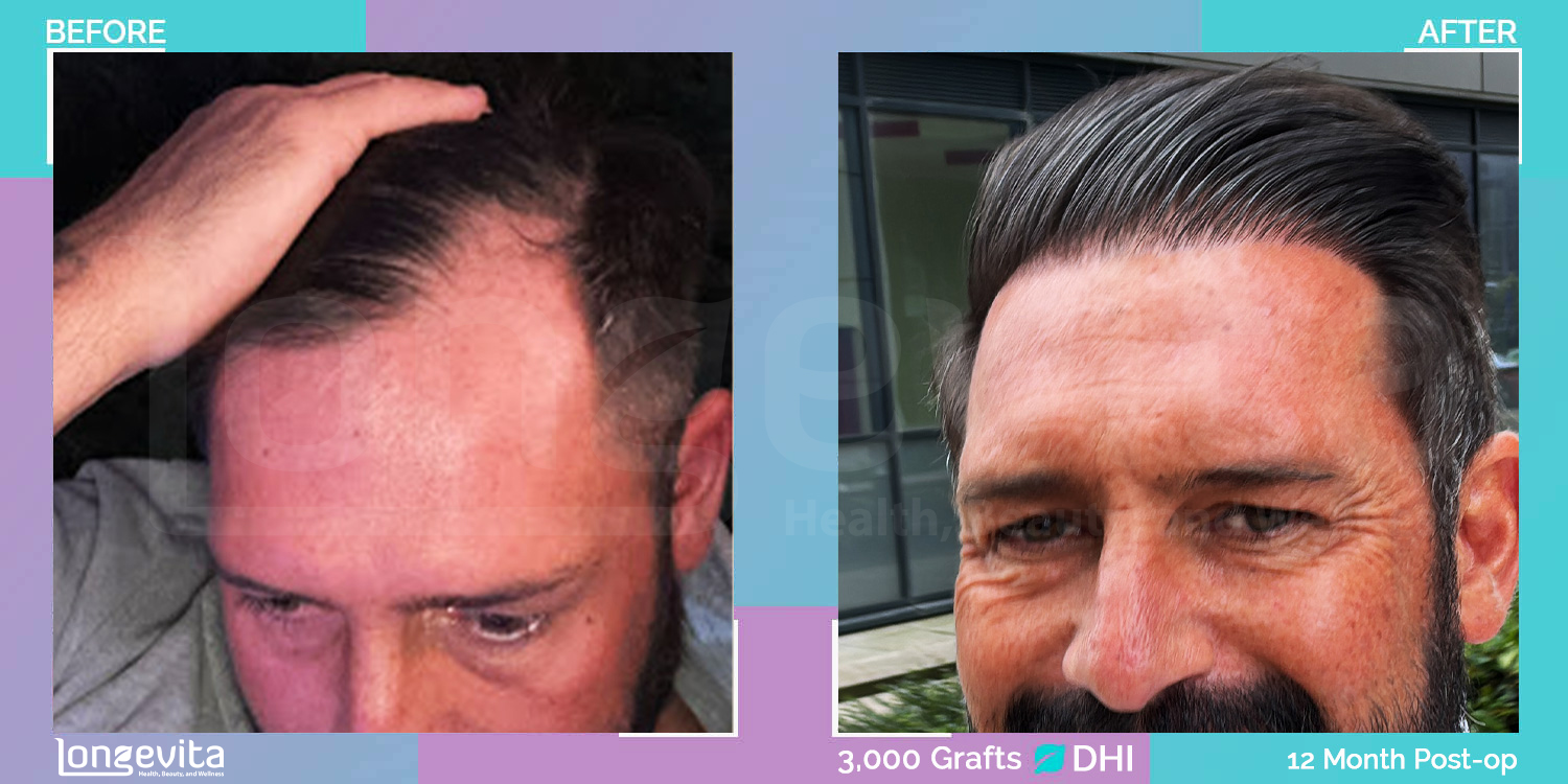 DHI hair transplant before and after, 3000 grafts, 1 zone covered, 30s male patient