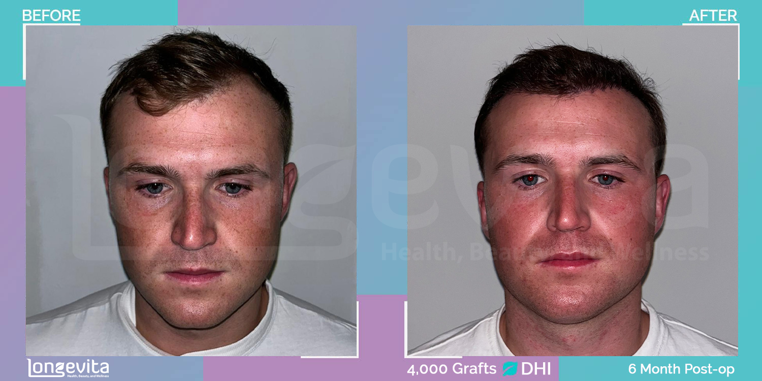 DHI hair transplant before and after, 4000 grafts, 3 zones covered, 20s male patient