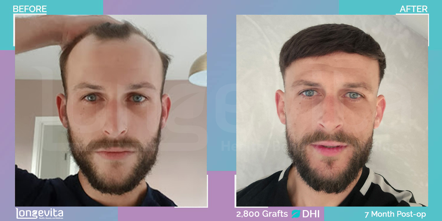 DHI hair transplant before and after, 2800 grafts, 1 zone covered, 30s male patient
