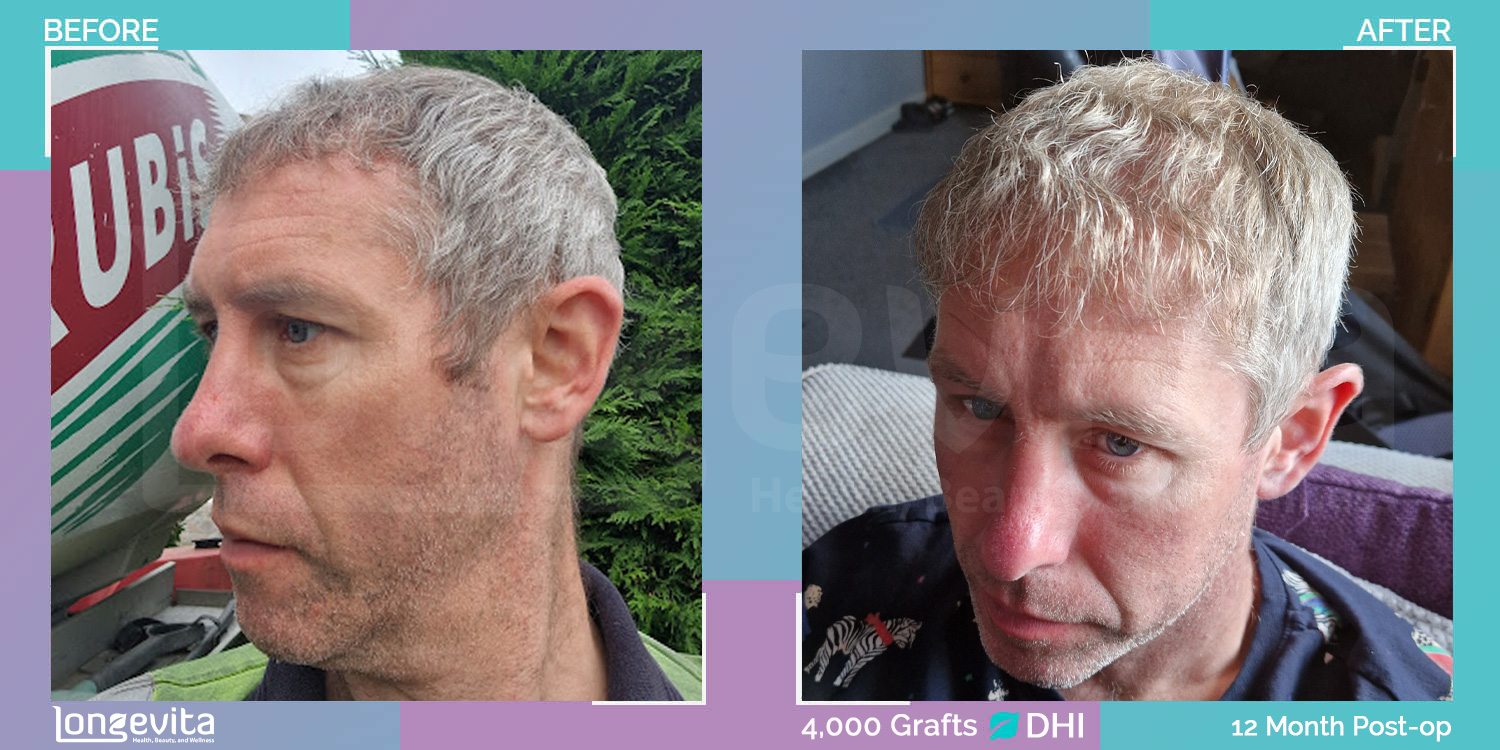 SAPPHIRE hair transplant before and after, 4000 grafts, 4 zones covered, 30s male patient