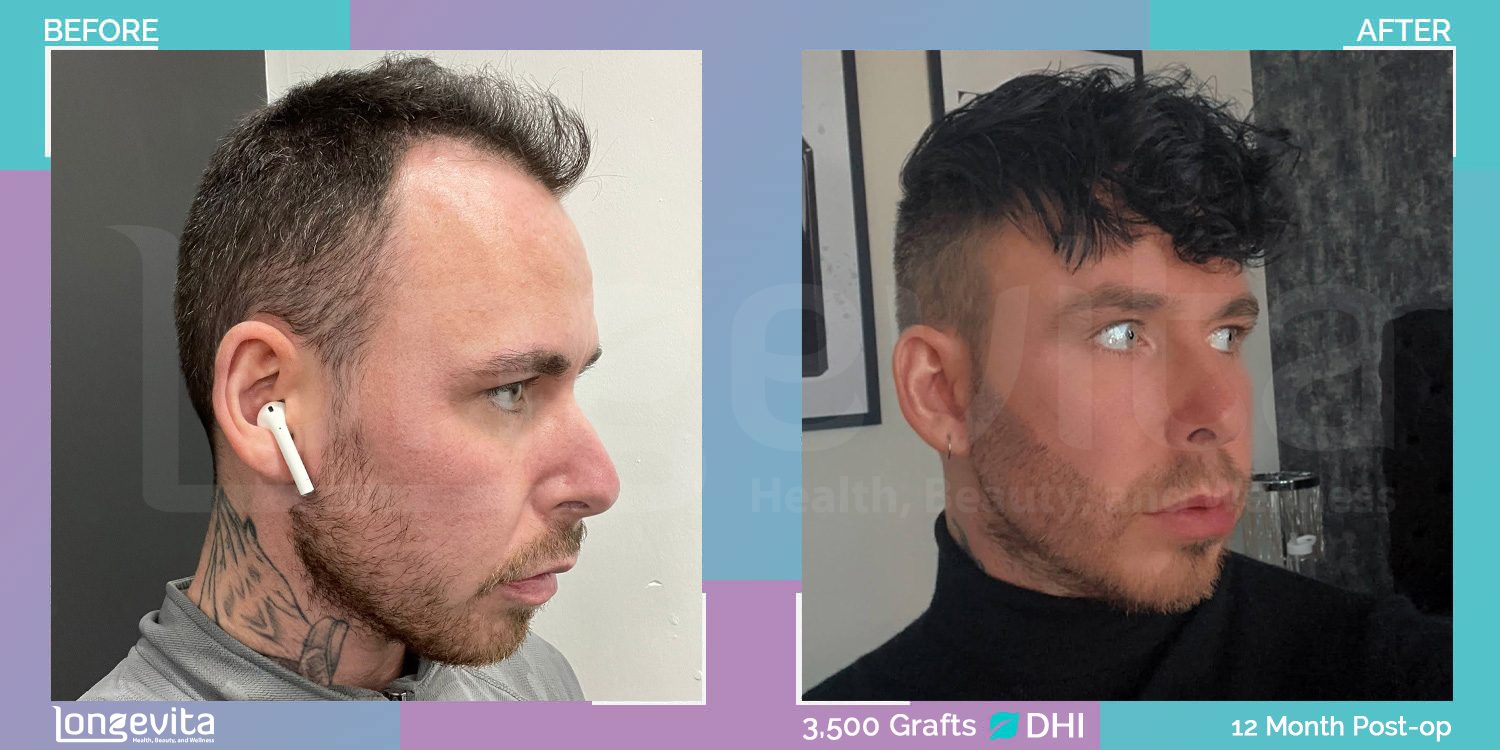 DHI hair transplant before and after, 3500 grafts, 2 zones covered, 20s male patient