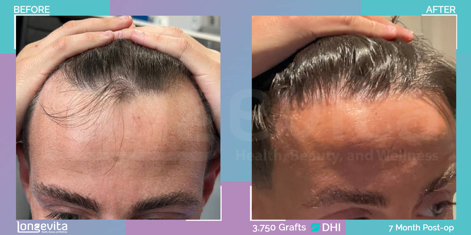 DHI hair transplant before and after, 3750 grafts, 2 zones covered, 20s male patient