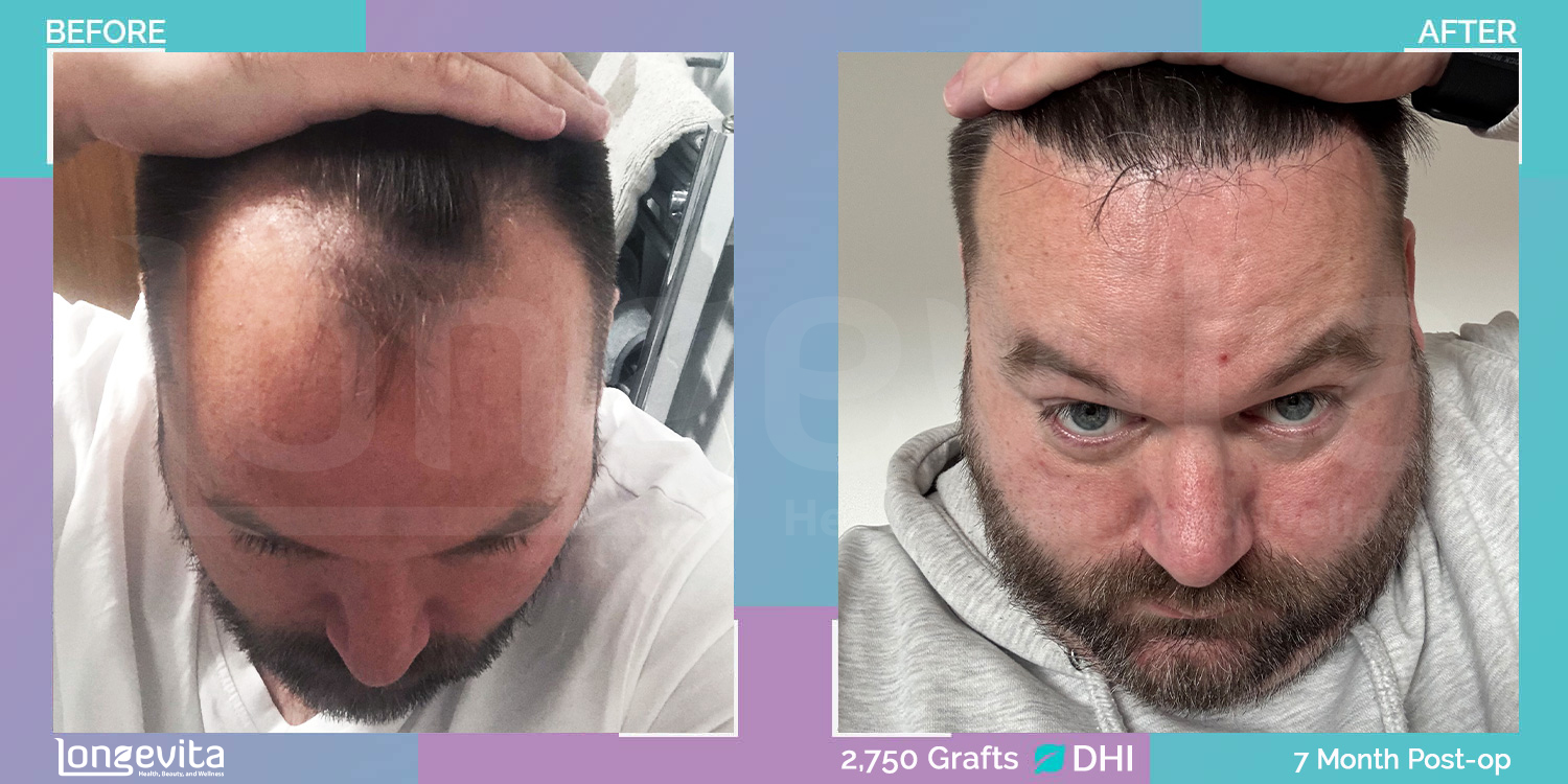 DHI hair transplant before and after, 2750 grafts, 2 zones covered, 30s male patient