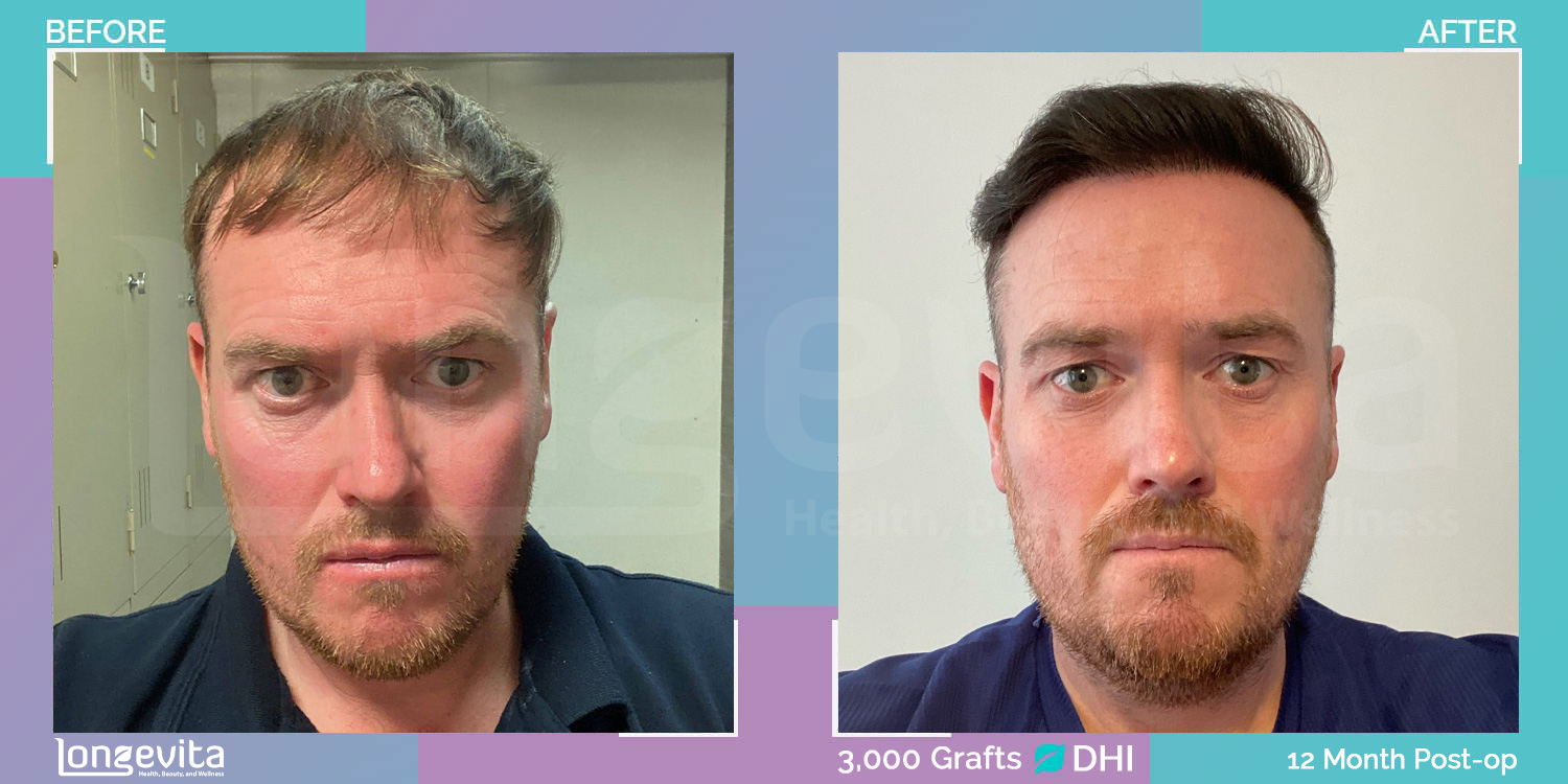 DHI hair transplant before and after, 3000 grafts, 2 zones covered, 40s male patient