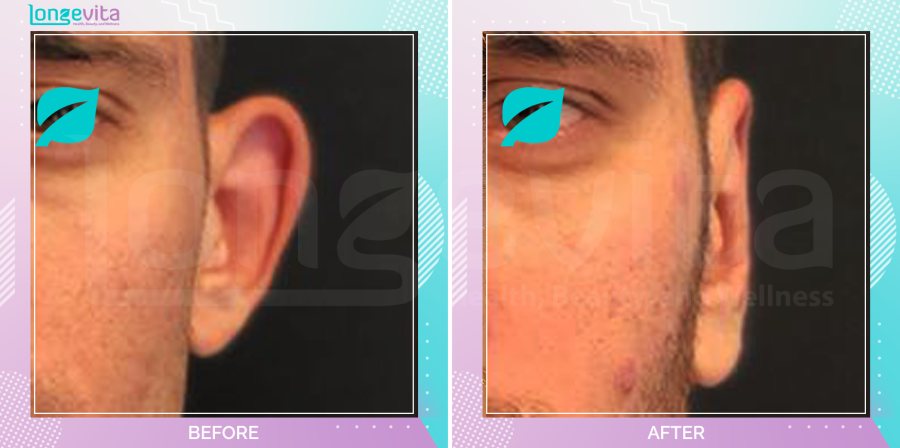 Otoplasty before and after, Face