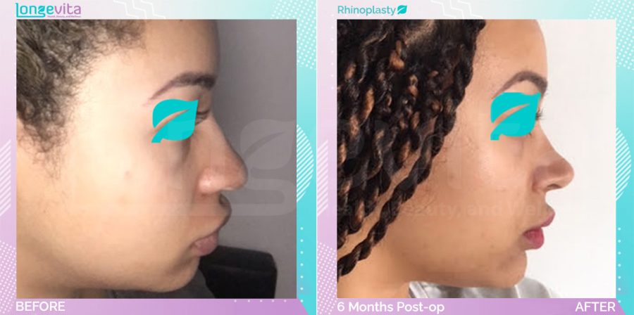 Rhinoplasty before and after, Face