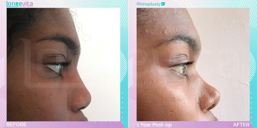 Rhinoplasty before and after, Face