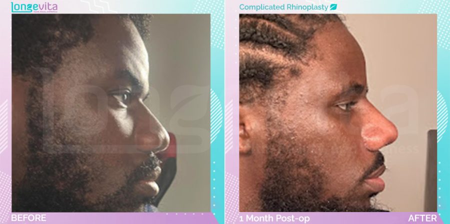 Complicated Rhinoplasty before and after, Face, male patient aged 18–29