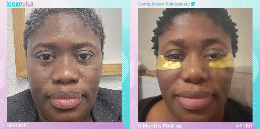 Complicated Rhinoplasty before and after, Face, 30s female patient