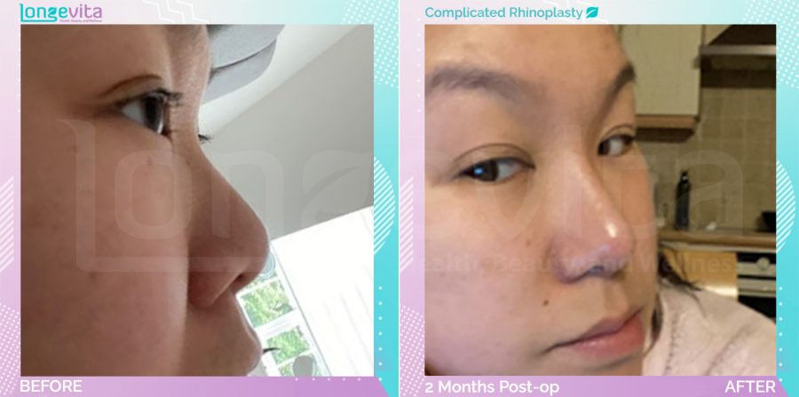 Complicated Rhinoplasty before and after, Face, 30s female patient