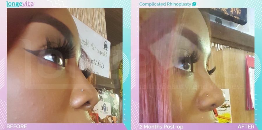 Complicated Rhinoplasty before and after, Face