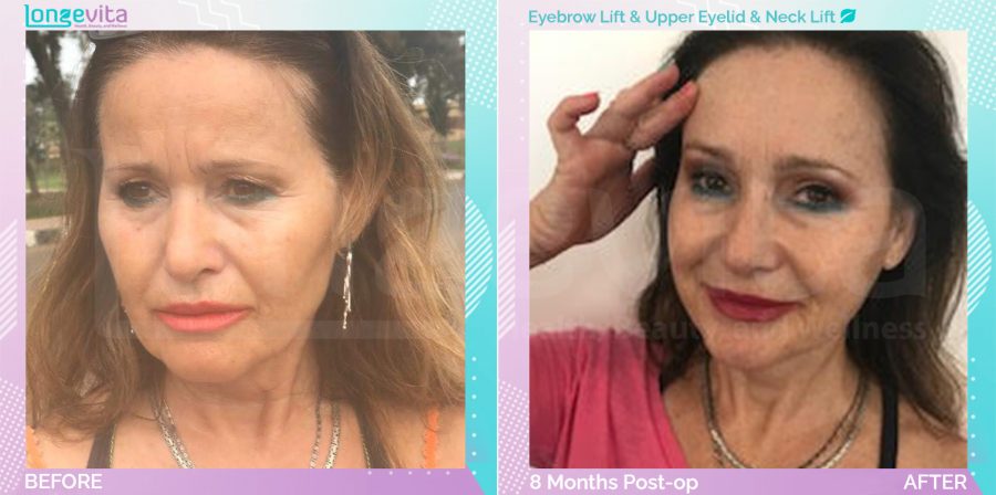 Eyebow Lift and Eyelid and Neck Lift before and after, Face, 50s female patient
