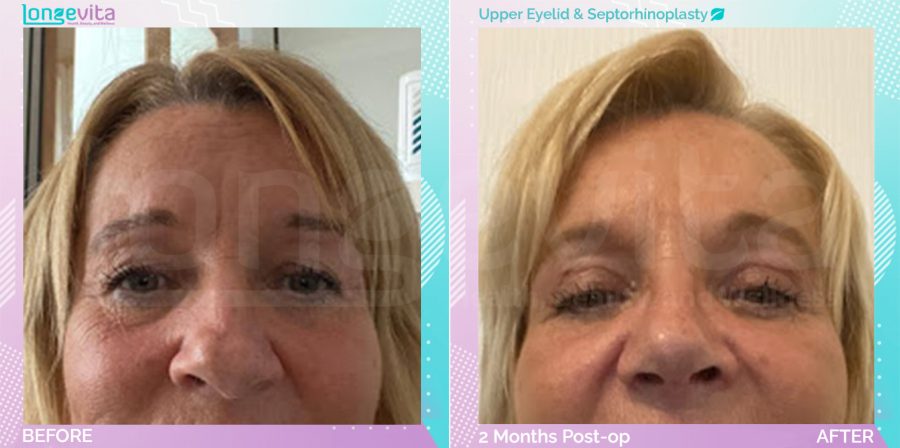 Eyelid and Septorhinoplasty before and after, Face, 50s female patient