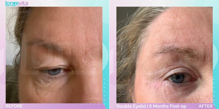 Eyelid before and after, Face, 40s female patient