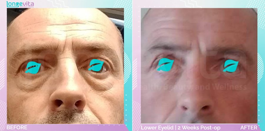 Eyelid before and after, Face, 40s male patient