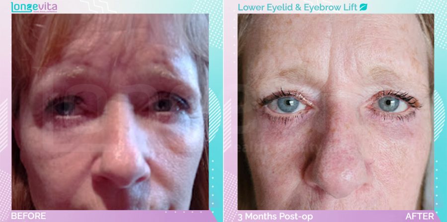 Eyebow Lift and Eyelid before and after, Face, 60s female patient