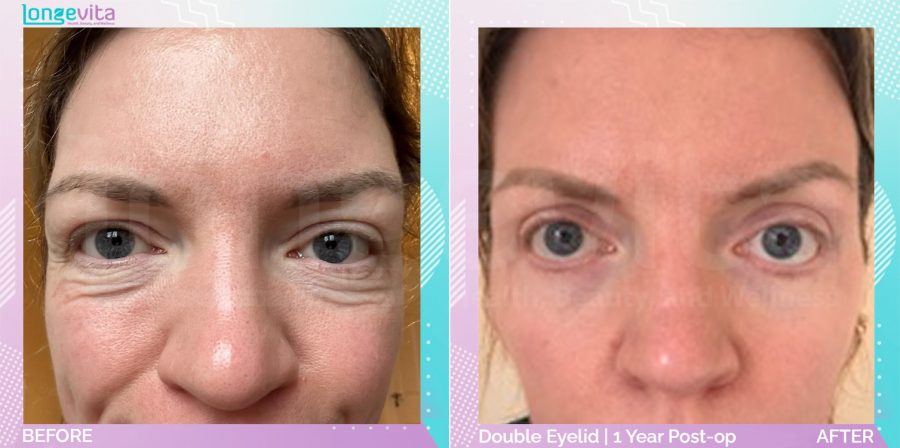Eyelid before and after, Face, 30s female patient