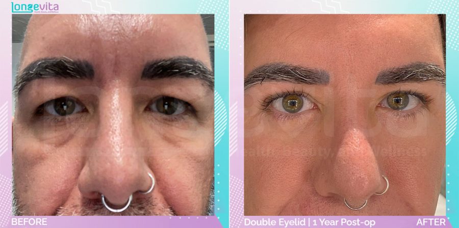 Eyelid before and after, Face, 40s male patient