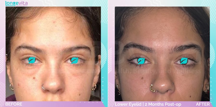 Eyelid before and after, Face, 20s female patient